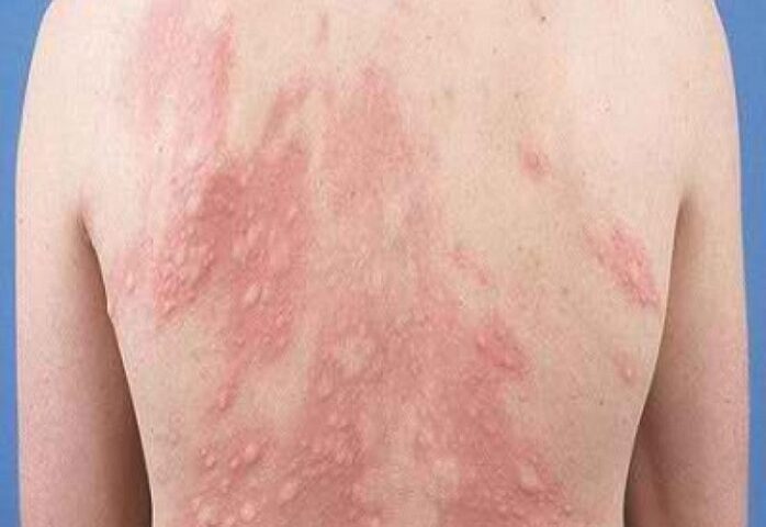 Chạm vào lông mèo bị nổi mề đay: Nguyên nhân & cách xử lý