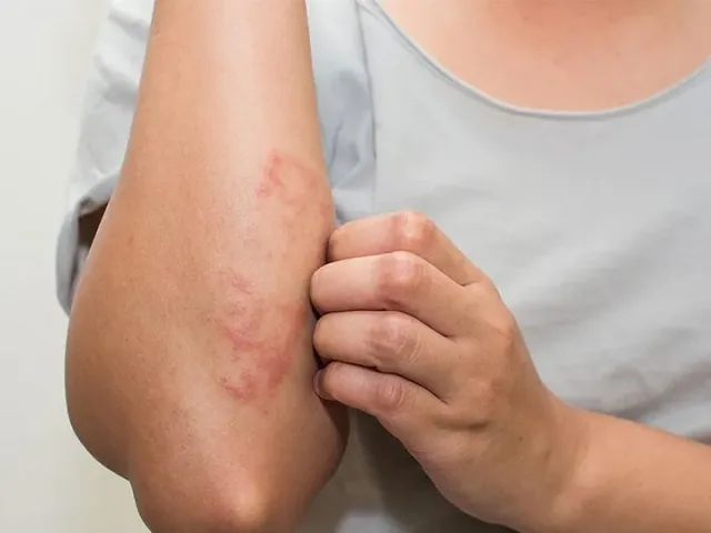 Chạm vào lông mèo bị nổi mề đay: Nguyên nhân & cách xử lý