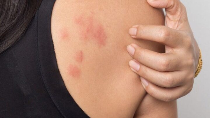 Chạm vào lông mèo bị nổi mề đay: Nguyên nhân & cách xử lý