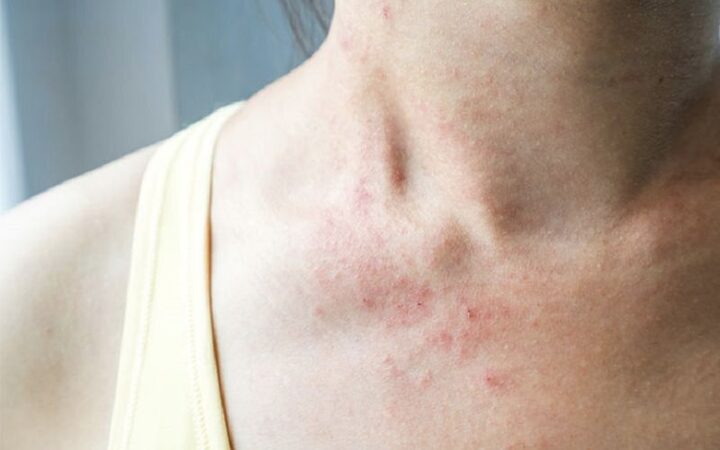 Chạm vào lông mèo bị nổi mề đay: Nguyên nhân và xử lý
