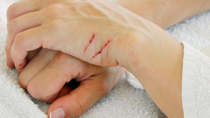 Bắt mèo bị cào cắn: Rủi ro và cách xử lý