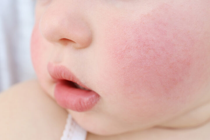 Trẻ Gần Mèo Bị Hen Suyễn: Hiểu Rõ Nguyên Nhân và Giải Pháp
