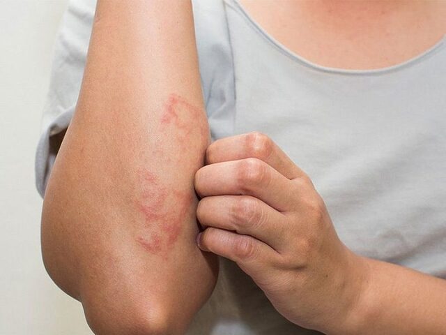 Chạm vào lông mèo bị nổi mề đay: Nguyên nhân & cách xử lý