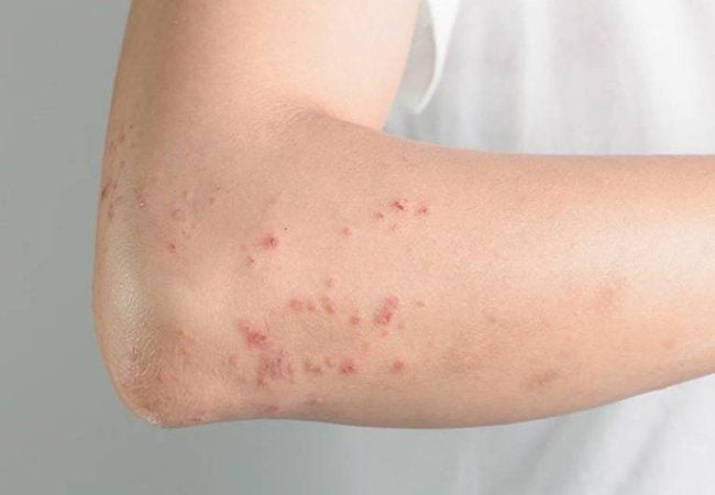 Bệnh Sán Chó Chữa Ở Đâu Hiệu Quả và Phác Đồ Điều Trị Mới Nhất