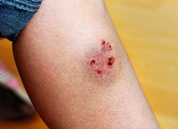 Vết Thương Chó Cắn Bị Sưng: Nguyên Nhân, Cách Xử Lý Và Phòng Ngừa Hiệu Quả - image 3