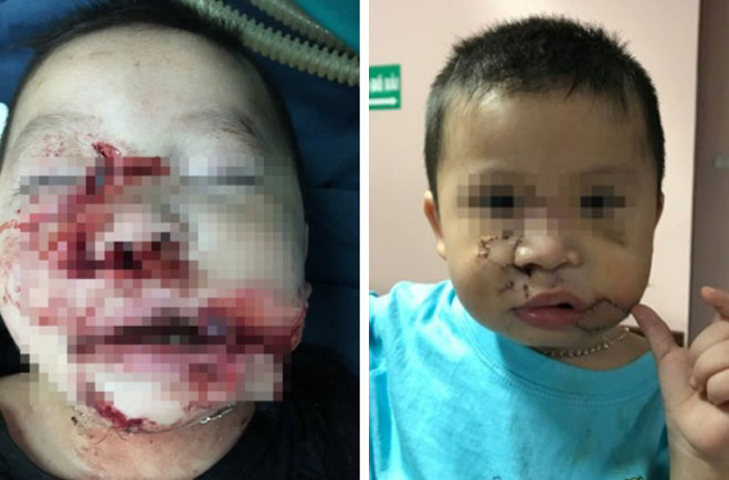 Trẻ Bị Chó Cắn Phải Làm Sao: Hướng Dẫn Chi Tiết Cấp Cứu Và Phòng Ngừa