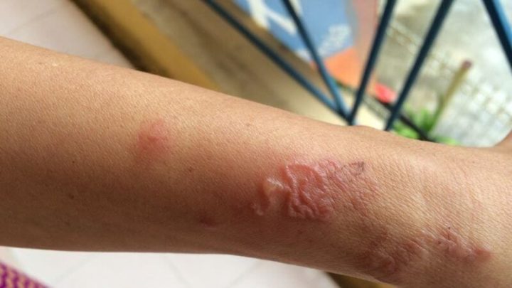 Bệnh Giun Đũa Chó Nên Kiêng Ăn Gì: Hướng Dẫn Chi Tiết
