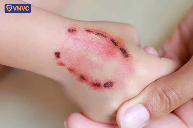 Sau Khi Bị Chó Cắn Bao Lâu Chích Ngừa & Phác Đồ Tiêm Dại