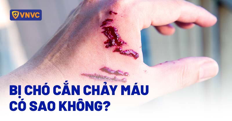 Bị Chó Nhà Cắn Chảy Máu Có Sao Không? Hướng Dẫn Chi Tiết