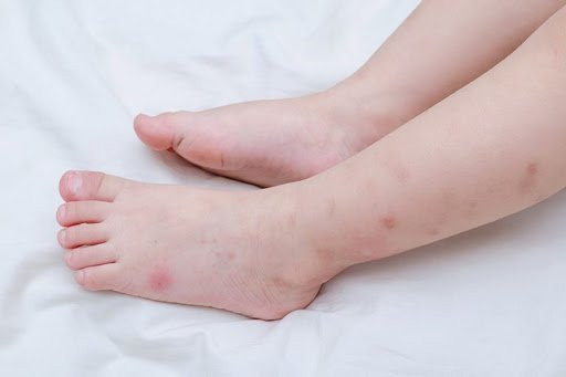 Hình ảnh trẻ nhỏ bị ve chó cắn, với vết đỏ sưng trên da non nớt, cảnh báo về nguy cơ từ ve đối với sức khỏe của bé.