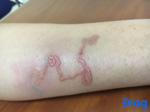 Người bị nổi mẩn ngứa, phát ban, là một trong các dấu hiệu nhiễm giun đũa chó