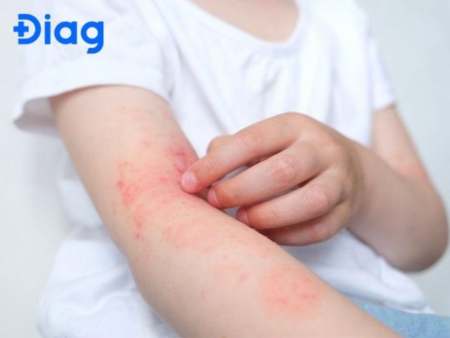 Nhiễm giun đũa chó thường gây ngứa da, nổi mẩn đỏ