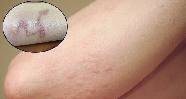 Bị Sán Chó Có Nguy Hiểm Không Và Mức Độ Ảnh Hưởng Sức Khỏe - image 3