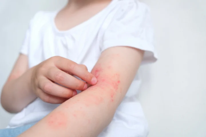 Phác Đồ Điều Trị Sán Chó Bộ Y Tế: Hướng Dẫn Chi Tiết