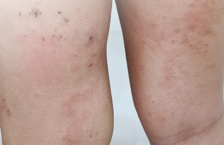 Nhiễm Ký Sinh Trùng Từ Chó Mèo: Nguyên Nhân, Triệu Chứng Và Cách Phòng Tránh