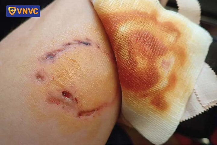 Sơ cứu vết thương sau khi bị chó cắn là cách không bị chó cắn lây bệnh