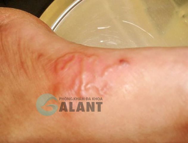 Thời Gian Ủ Bệnh Sán Chó: Điều Cần Biết Để Phòng Ngừa