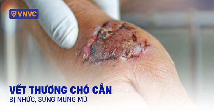 Vết Thương Chó Cắn Bị Sưng: Nguyên Nhân, Cách Xử Lý Và Phòng Ngừa Hiệu Quả - image 2