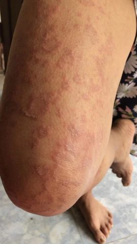 Bệnh sán chó có nguy hiểm không?