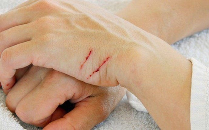 Bị Chó Cắn Xước Nhẹ Ở Chân Có Sao Không? Cách Xử Lý Và Nguy Cơ Nhiễm Trùng Bị chó cắn xước nhẹ ở chân có sao không?