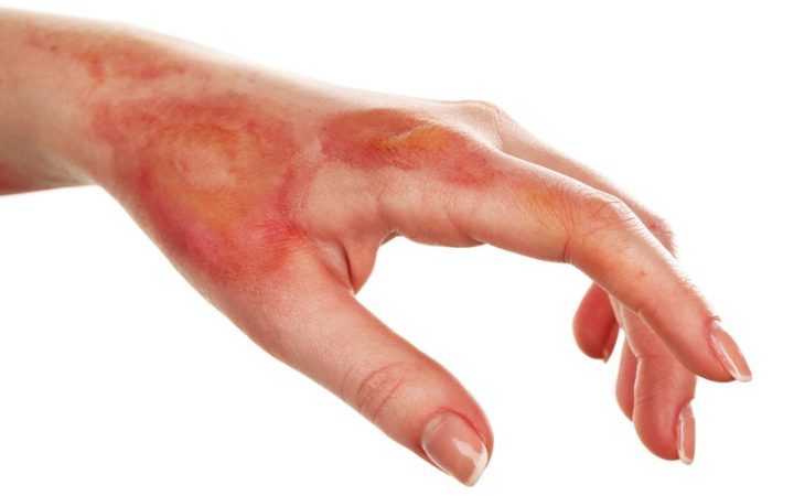 Bị Phỏng Nên Làm Gì? Hướng Dẫn Sơ Cứu Và Chăm Sóc Vết Thương Hiệu Quả Bị Phỏng Nên Làm Gì? Hướng Dẫn Sơ Cứu Và Chăm Sóc Vết Thương Hiệu Quả