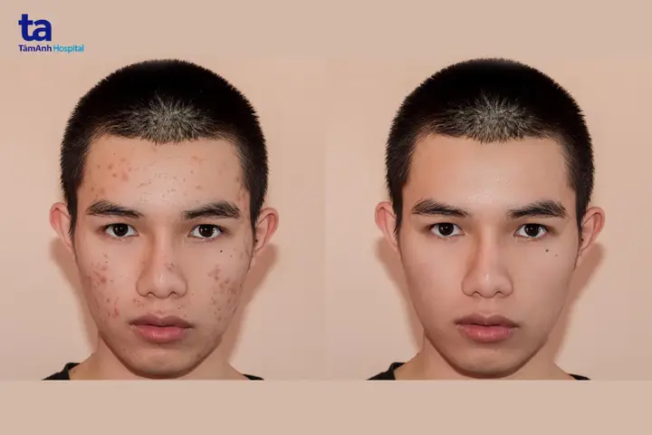 Cá La Hán Bị Nổi Mụn: Nguyên Nhân, Cách Trị Và Phòng Ngừa Hiệu Quả cá la hán bị nổi mụn