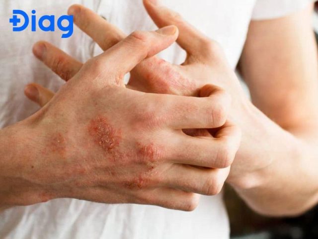 Triệu chứng của bệnh sán chó