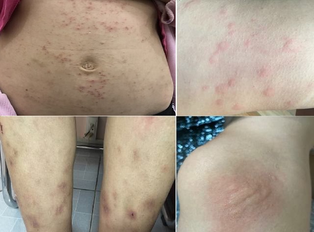 Cách trị bệnh sán chó tại nhà