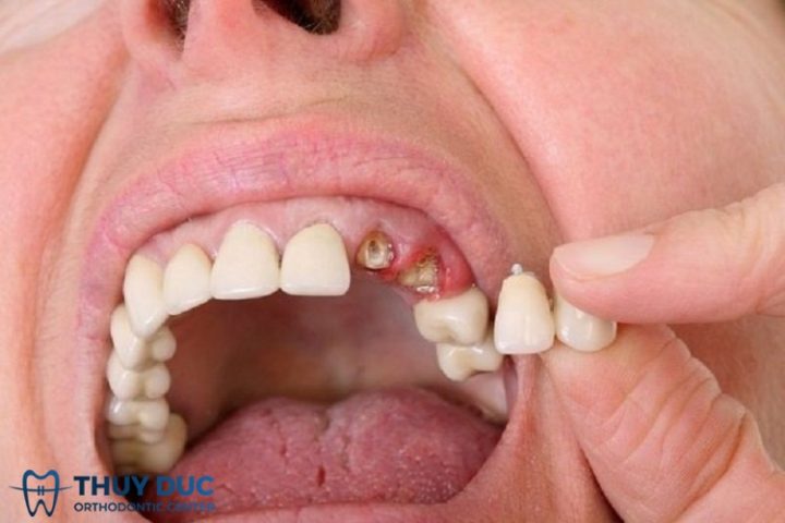 Ý nghĩa tâm linh của giấc mơ rụng răng