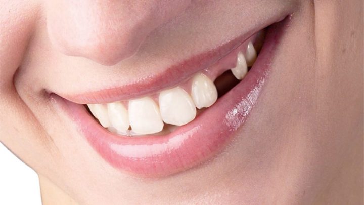 Các loại giấc mơ liên quan đến rụng răng