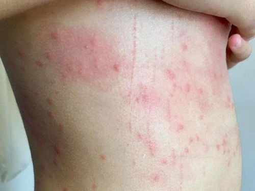 Triệu chứng của chó bị nhiễm sán